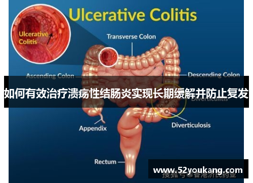 如何有效治疗溃疡性结肠炎实现长期缓解并防止复发